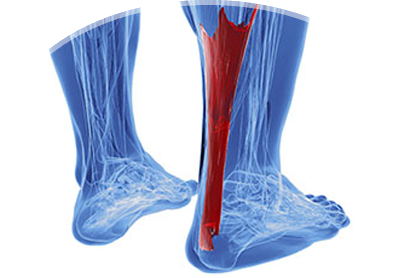 achilles tendon