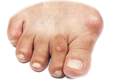bunions