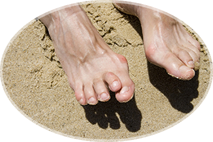 hammertoes
