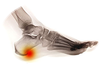 heel spurs