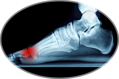 neuroma (morton's)