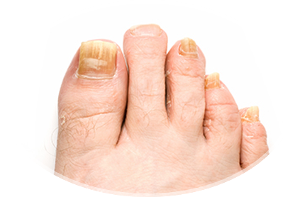 toenail fungus